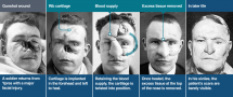 Facial Wounds from Shrapnel Strike in WWI