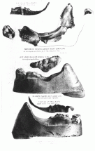Parkman's False Teeth and Victim's Jaw Bone