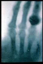First X-ray - 1895 - Anna Bertha Roentgen's Hand